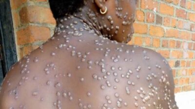 South Africa confirms 18 cases of Mpox