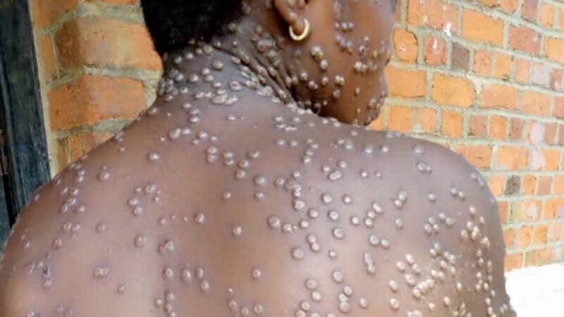 South Africa confirms 18 cases of Mpox
